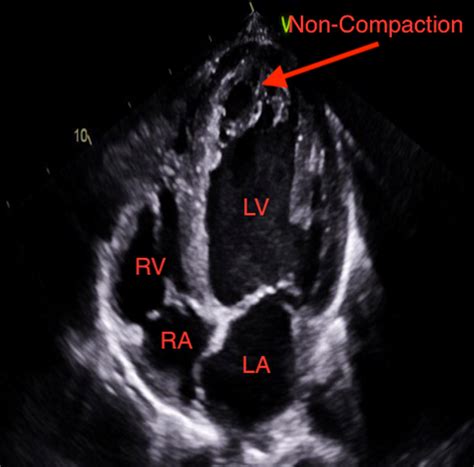 lv non compaction syndrome